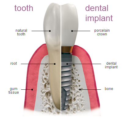About dental implants