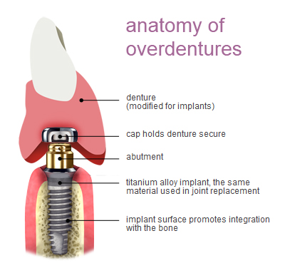 About overdentures